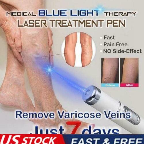 Blue Light Therapy Pen For Varicose And Spider Veins - BRANDNMART
